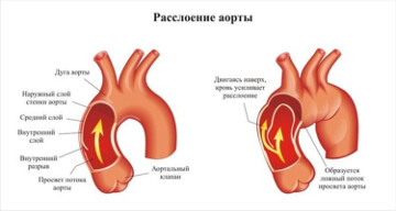 anevrizma aorty1