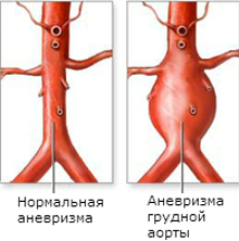 anevrizma aorty grudnoj