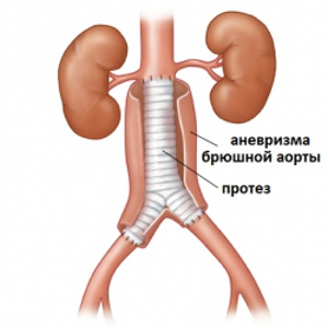 anevrizma aorty operazija