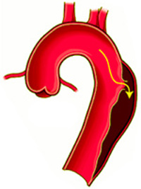 anevrizma aorty rasslaivajushaja