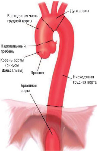 anevrizma aorty voshodjashej