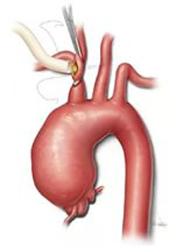 anevrizma aorty voshodjashej1