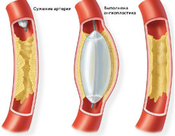 angioplastika1