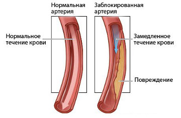 ateroslkeroz brahiocefalnyh arterij1