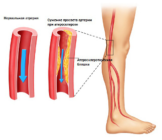 bolezni sosudov nog