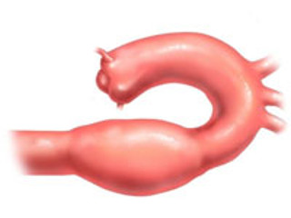 lechenije anevrizmy aorty2