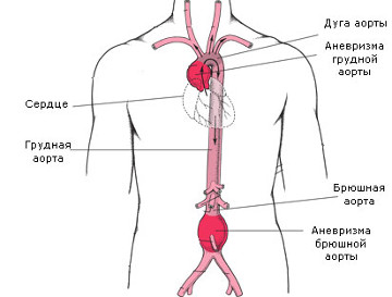 simptomy anevrizmy aorty2