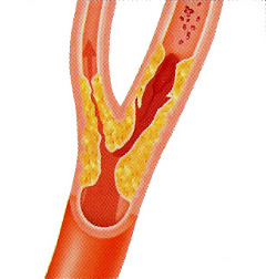 stenoz sonnoj arterii1