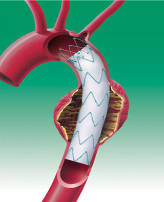 stent graft1