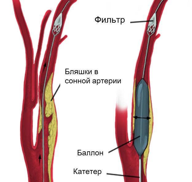 sonnaya arteriya