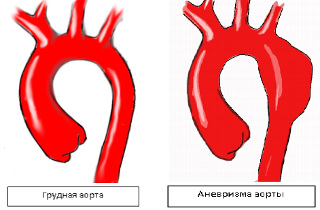 anevrizma aorty