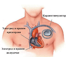kardiostimulator operatsija