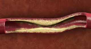 lechenije stenoza