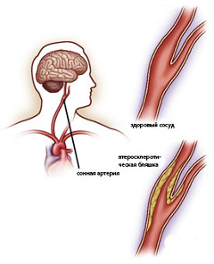 simptomy ateroslkeroza sonnyh arterij1